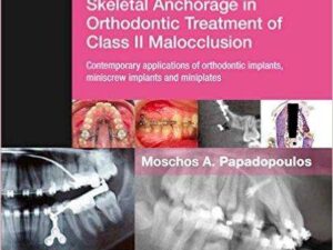 Skeletal anchorage in orthodontic treatment of Class II malocclusion