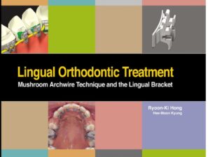 Lingual Orthodontic Treatment – Mushroom Archwire Technique and the Lingual Bracket