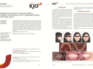 Hong RK, Lim SM, Heo JM, Baik SH. Orthodontic treatment of gummy smile by maxillary total intrusion with a midpalatal absolute anchorage system. Korean J Orthod 2013;43(3):147-158.