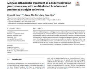 Hong RK, Lim SM, Ahn JH. Lingual orthodontic treatment of a bidentoalveolar protrusion case with multi-slotted brackets and preformed straight archwires. Orthod Waves 2019;78:74-83.