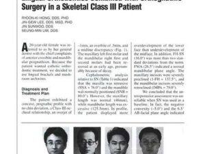 Hong RK, Lee JG, Sunwoo J, and Lim SM. Lingual orthodontics combined with orthognathic surgery in a skeletal Class III patient. J Clin Orthod 2000;34:403-408.